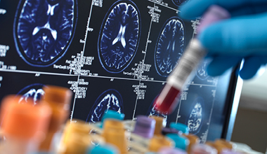 Diagnostic imaging, including an MRI, and blood tests used in the diagnosis of Kaposi Sarcoma