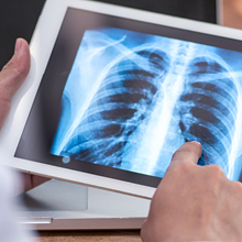 Chest X-ray used to assess the lungs for signs of Kaposi Sarcoma